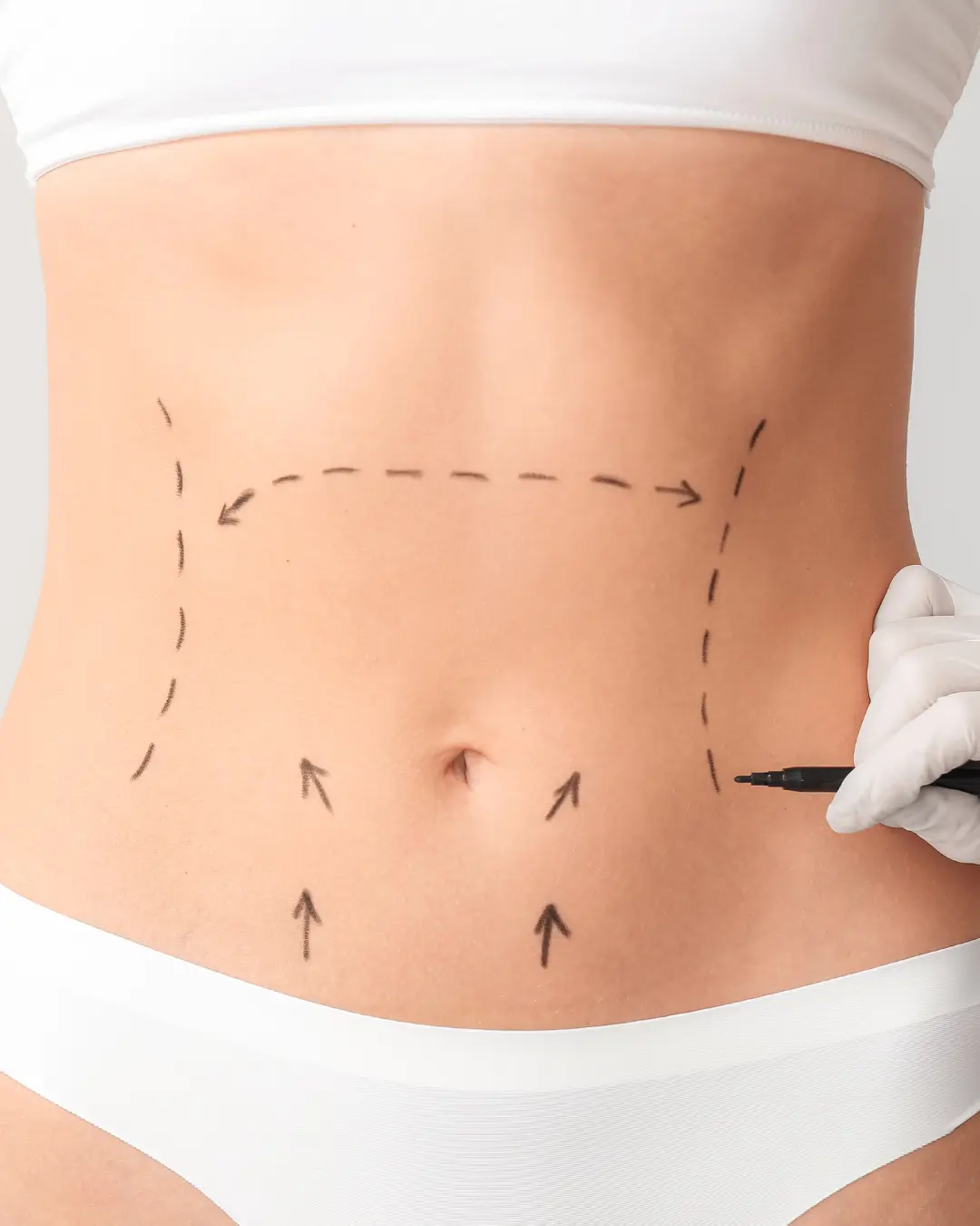Resultado de abdominoplastia: abdomen firme y definido