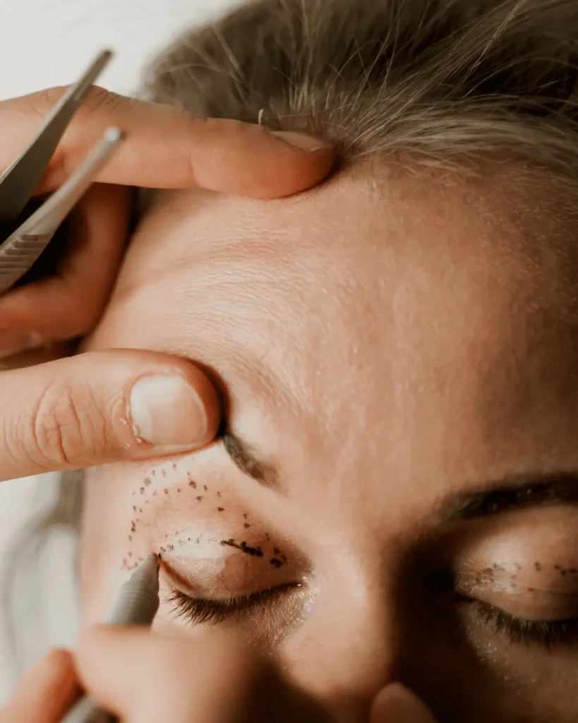 Blefaroplastia