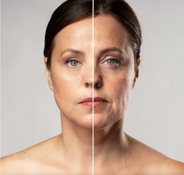 Antes y después tensores faciales